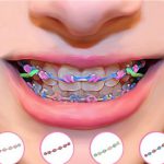 3 Aplikasi Kamera Behel Gigi Cantik dan Gratis!